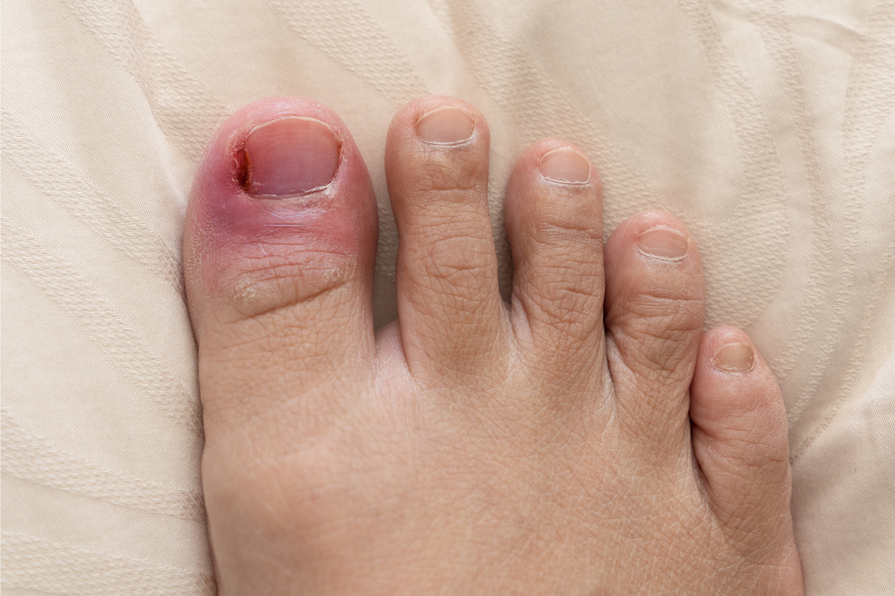 ingrown toenail Archives  The Podiatry Group of South Texas